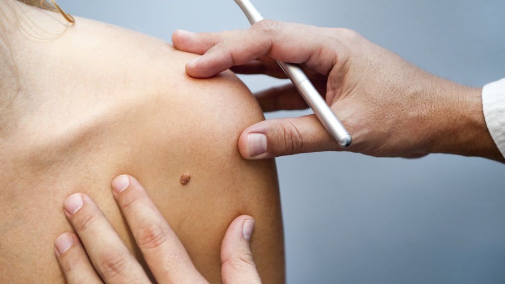 Skin cancer study looks at ways to diagnose, treat disease faster