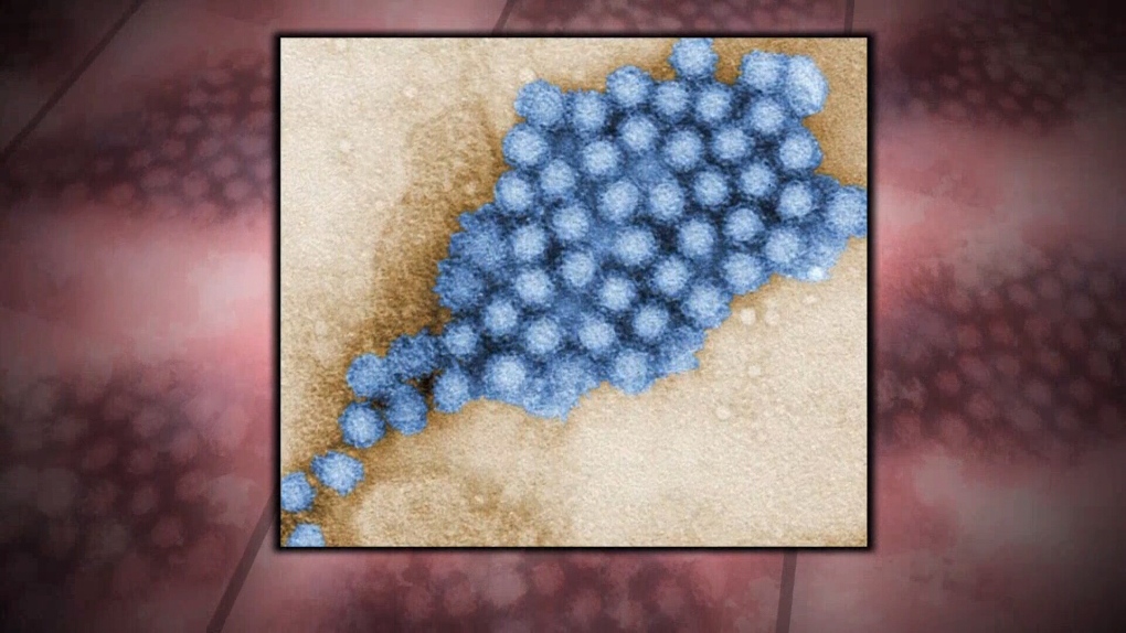 Norovirus likely mixing in Sudbury, has similar symptoms to COVID-19, health unit says