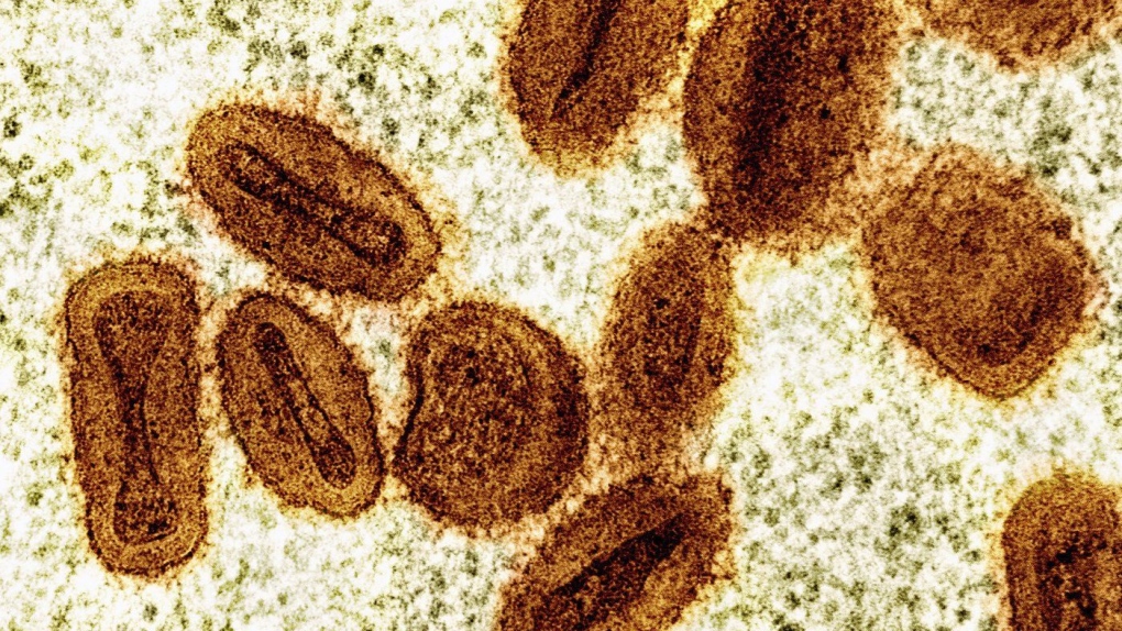 Mpox virus: United States confirms first case, in a traveler