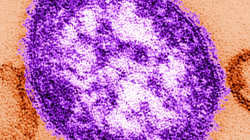 Measles Outbreak Confirmed in Montreal, Laval and Laurentians