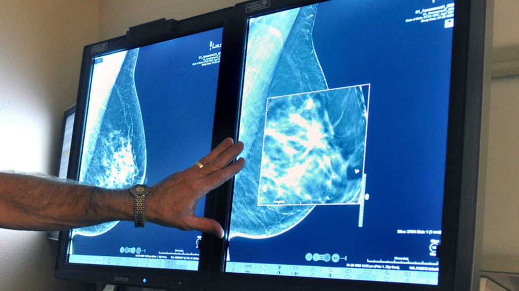 Ontario lowers the age for self-referral mammogram breast screening to age 40