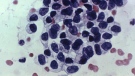 This photomicrograph shows cancerous cells detected by a Pap test, named after Georgios Papanicolaou, the Greek doctor who invented the test.