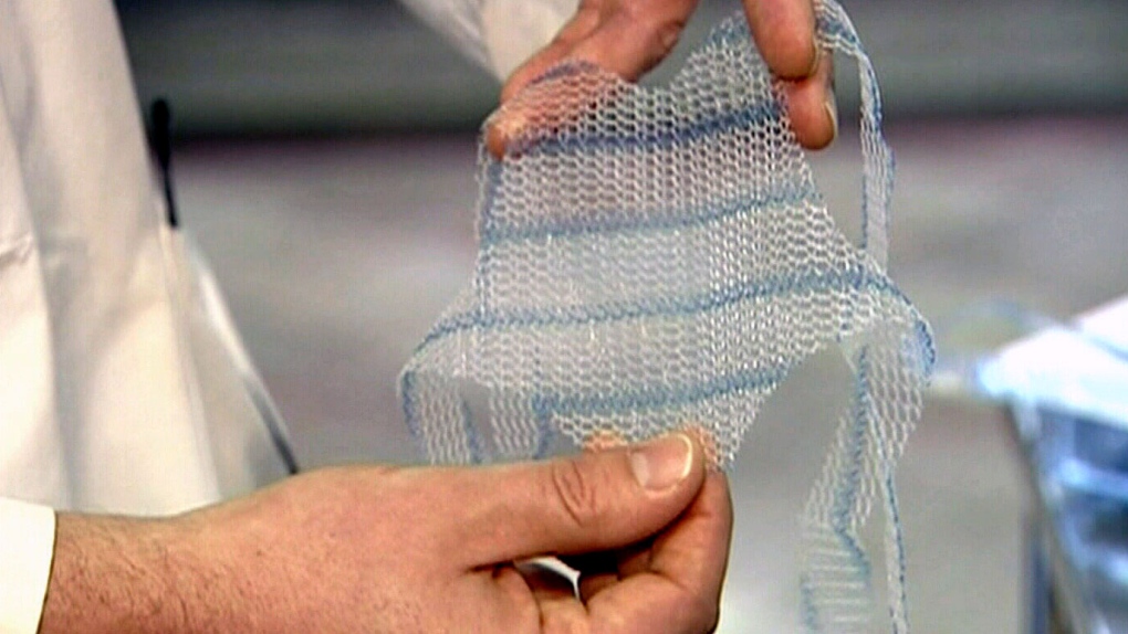 One in 30 require further surgery after vaginal mesh treatment: study | CTV  News