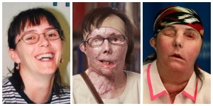 Lye attack victim reveals her newly-transplanted face