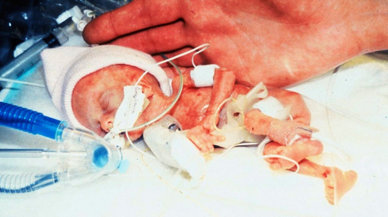 This June 1989 file photo provided by the Loyola University Medical Center in Maywood, Ill., shows Madeline Mann shortly after her premature birth weighing 9.9 ounces. She is now an honors student in psychology at Augustana College in Rock Island, Ill. (Loyola University Medical Center / A. Hayashi)