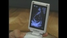 A point-of-care ultrasound is seen at the London Health Sciences Centre in London, Ont.