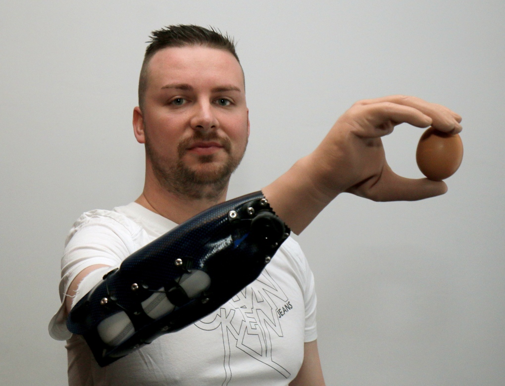 Three Austrian men get bionic hands after amputation