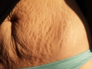 This undated self-portrait image released by Canadian student Karly Vedan, shows stretch marks along her stomach. (Karly Vedan via AP)