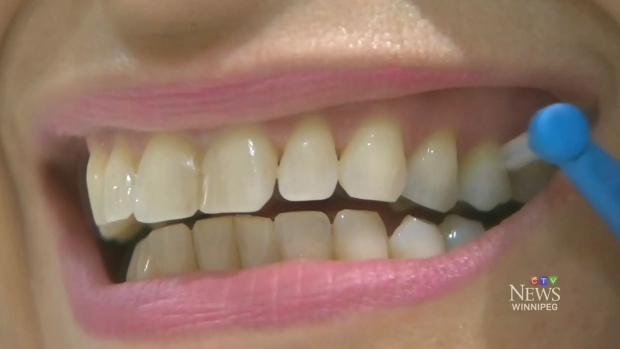 Allergic to flossing? It can happen, small study finds | CTV News