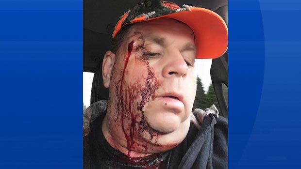 N.B. man injured by misfiring rifle: 'The gun went one way and I went the  other' | CTV News
