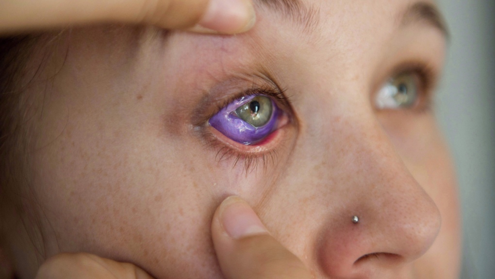 Ontario moves to ban eye tattooing, implanting eye jewelry | CTV News