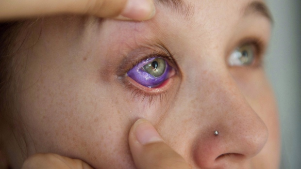 Eye tattooing, eye jewelry implants to be banned in Ontario | CTV News