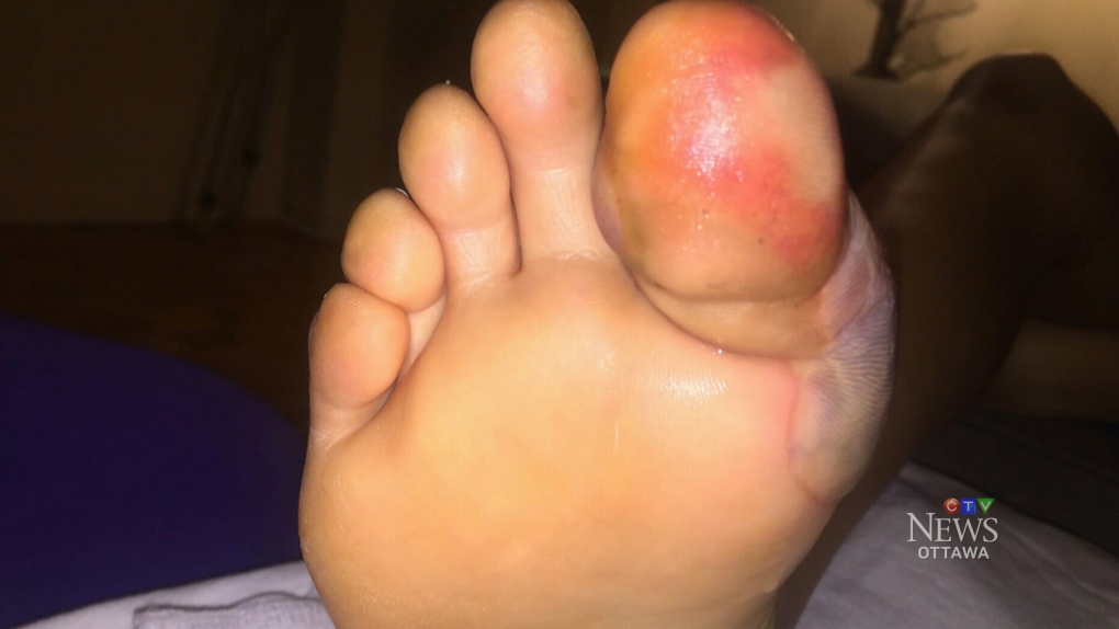 frostbite foot