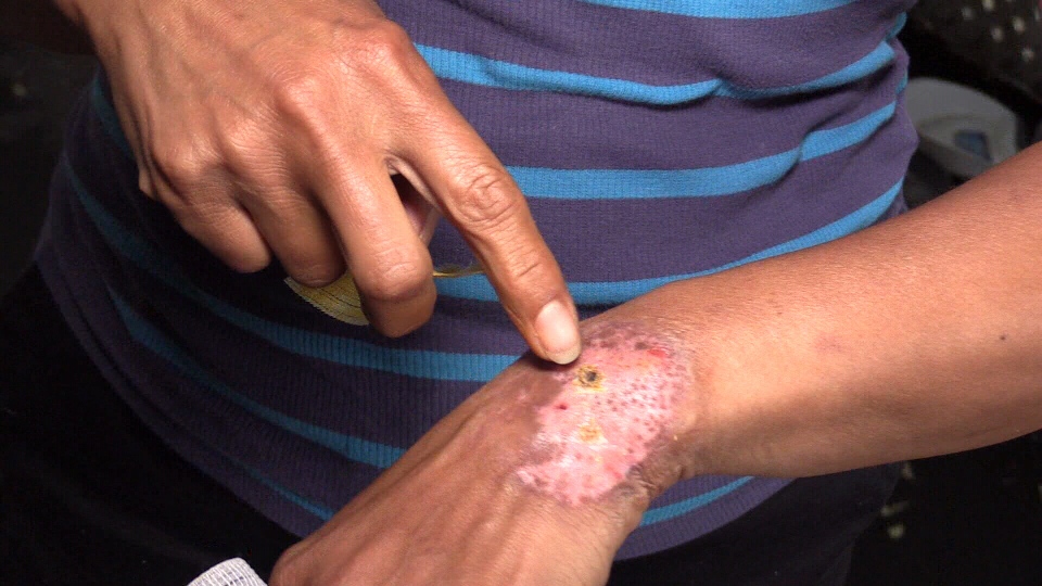 Spider bite causes flesh-eating damage to woman's wrist | CTV News