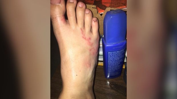 Warning about walking barefoot after teen contracts hookworms at Florida  beach