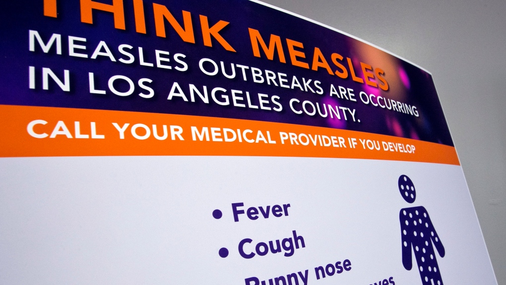 Measles LA