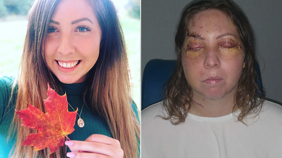 Ottawa woman badly beaten at Mexican resort | CTV News