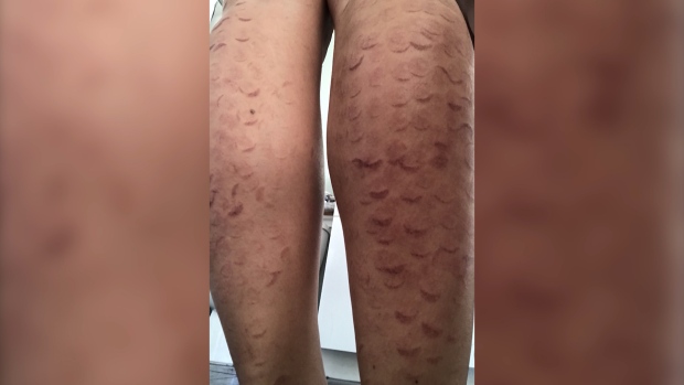Laser Hair Removal Left Exotic Dancer With Unsightly Marks Lawsuit Alleges Ctv News