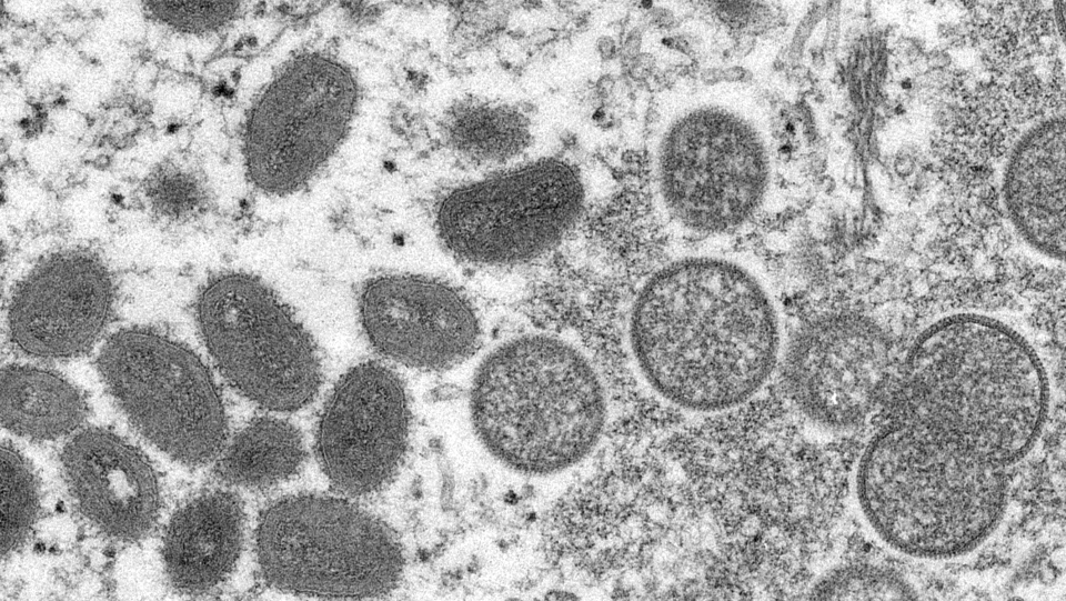 Monkeypox: Sudan detects first case | CTV News