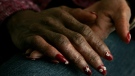 The hands of Edjuana Ross, at her home Monday, Jan. 30, 2006, in Park Forest, Ill., show the scars of lupus, a disease that attacked her skin, brain and heart.  (AP Photo/Charles Rex Arbogast)