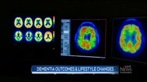 New study giving hope to people with dementia