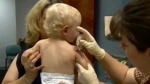 Cases of whooping cough are on the rise in Quebec 