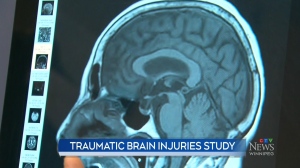 Traumatic brain injuries and anemia