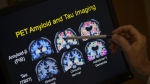 A doctor points to PET scan results that are part of a study on Alzheimer's disease at Georgetown University Hospital, on Tuesday, May 19, 2015, in Washington. (AP Photo/Evan Vucci, File)