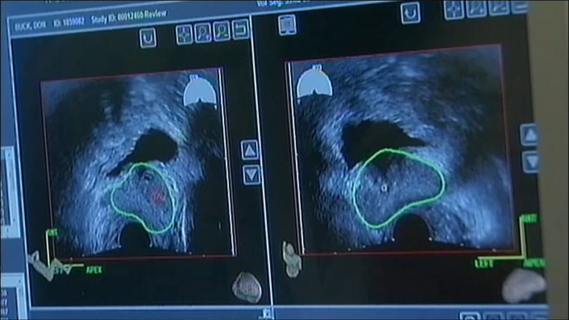 New radiation therapy hailed as game-changer