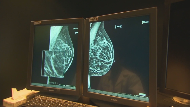 Mammogram screening