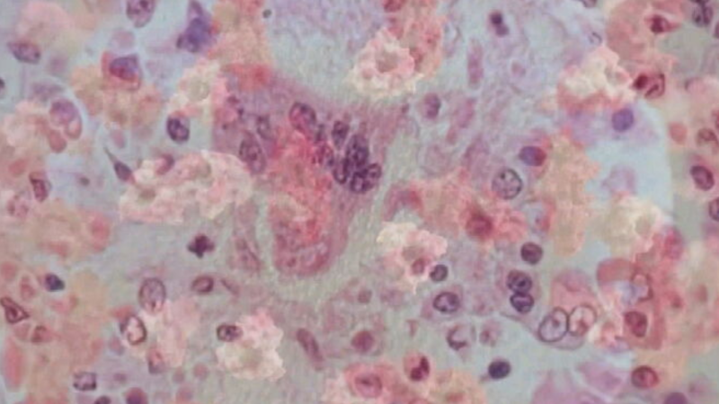 Measles under a microscope in this undated file image.